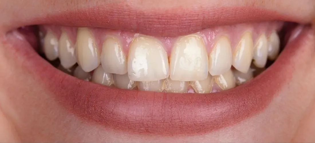 Blanqueamiento • Especialidades y tratamientos Odontológicos en Salta