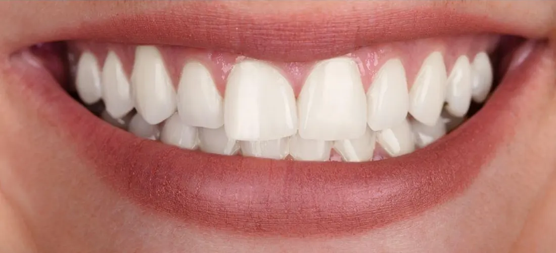 Blanqueamiento • Especialidades y tratamientos Odontológicos en Salta