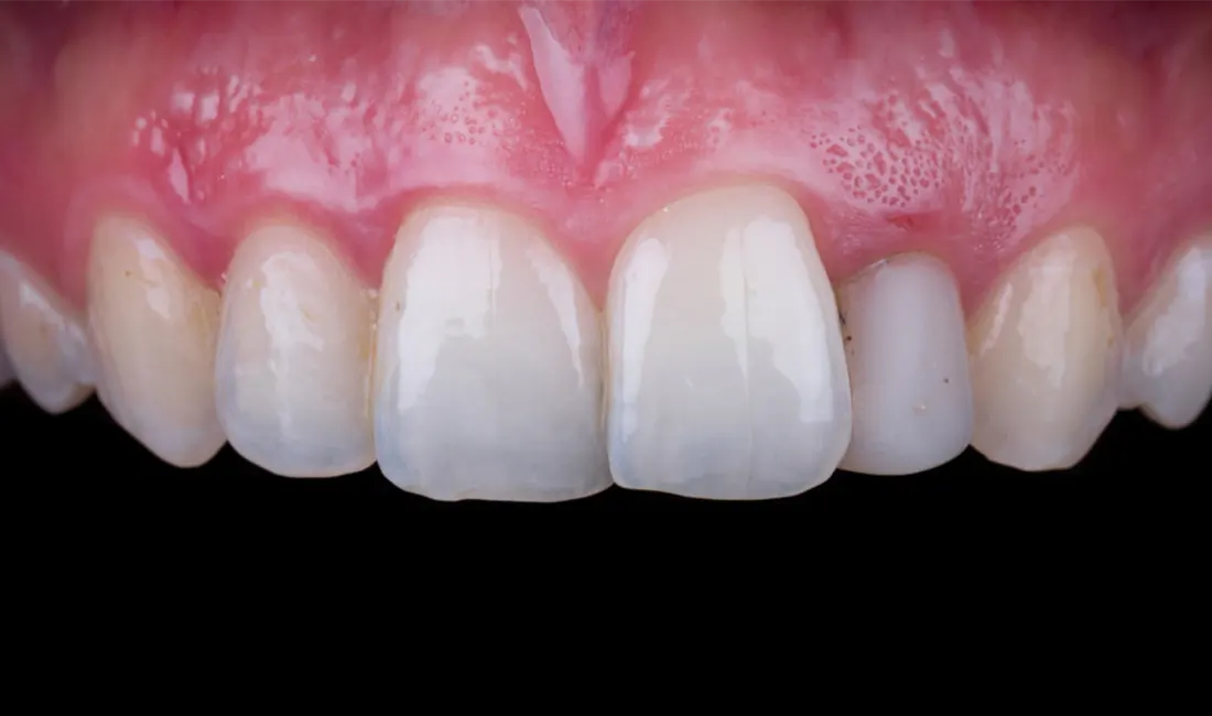 Carillas dentales • Especialidades y tratamientos Odontológicos en Salta