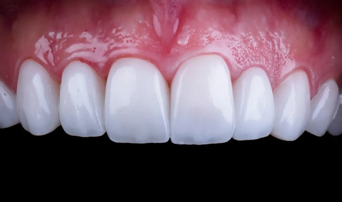 Carillas dentales • Especialidades y tratamientos Odontológicos en Salta