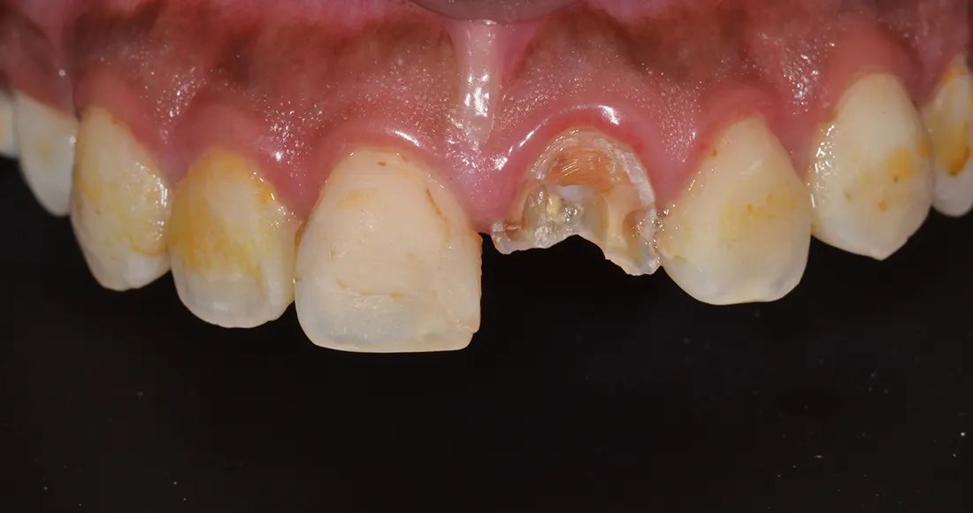 Coronas cerámicas • Especialidades y tratamientos Odontológicos en Salta