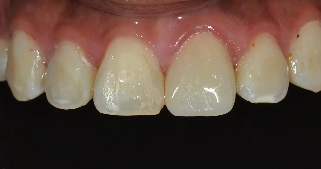 Coronas cerámicas • Especialidades y tratamientos Odontológicos en Salta