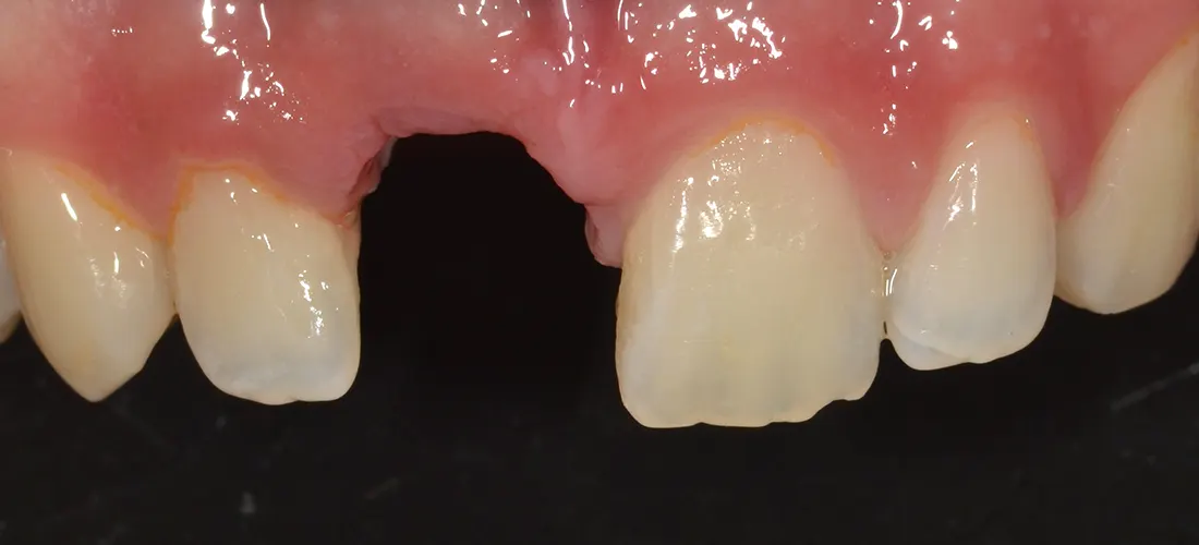 Implantes dentales • Especialidades y tratamientos Odontológicos en Salta
