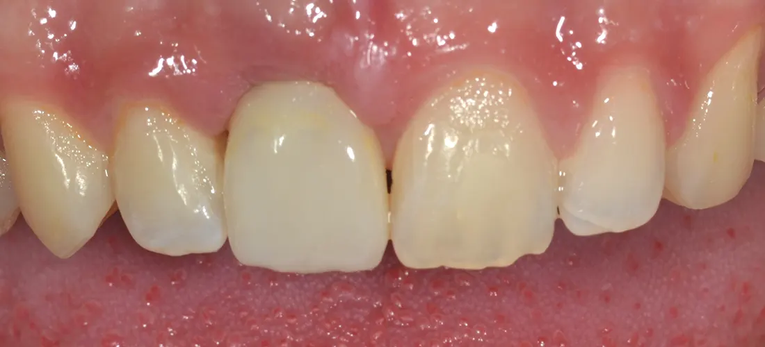 Implantes dentales • Especialidades y tratamientos Odontológicos en Salta