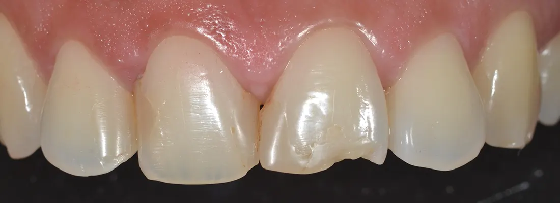 Restauraciones dentales • Especialidades y tratamientos Odontológicos en Salta