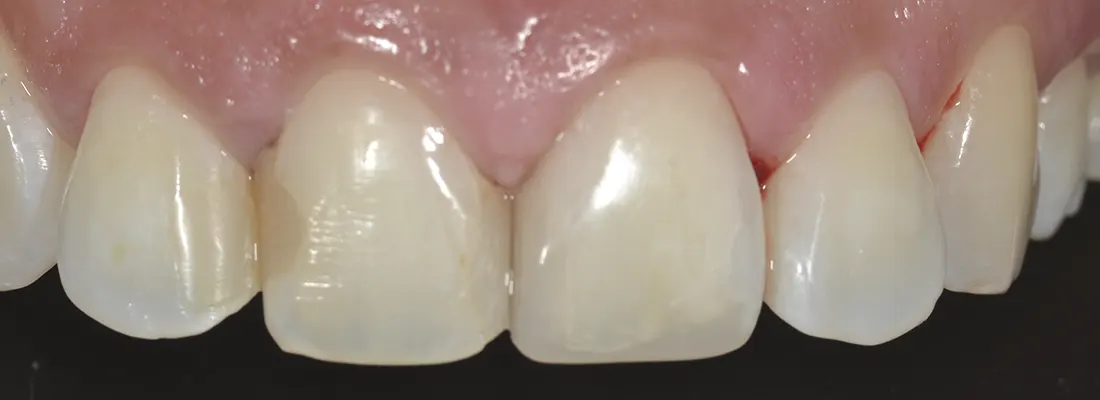 Restauraciones dentales • Especialidades y tratamientos Odontológicos en Salta